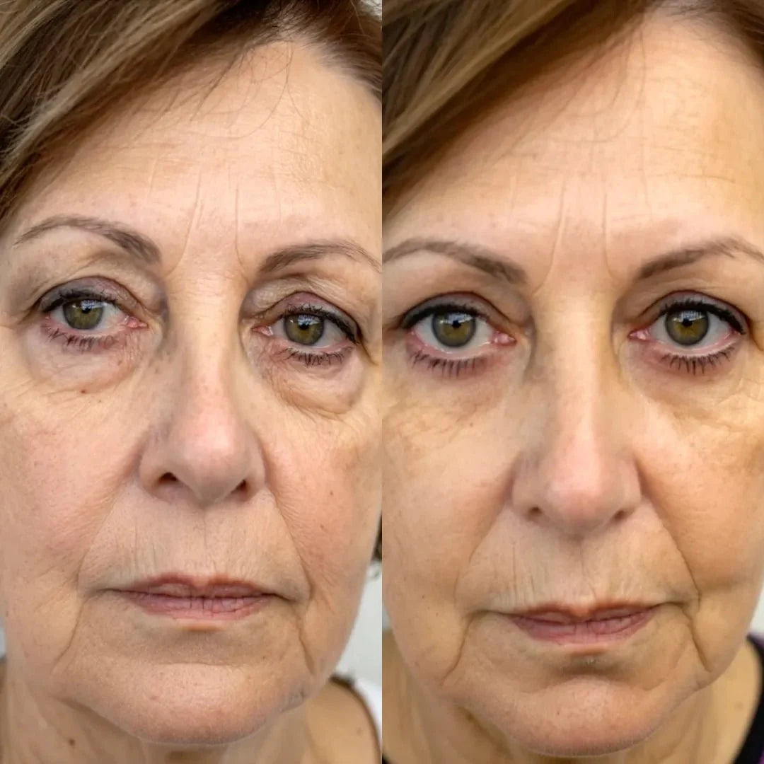 Pure Viren® 2 en 1 - terapia de luz roja + EMS para eliminar las bolsas de los ojos.