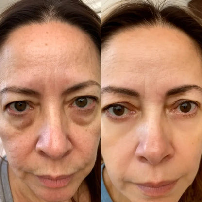 Pure Viren® 2 en 1 - terapia de luz roja + EMS para eliminar las bolsas de los ojos.